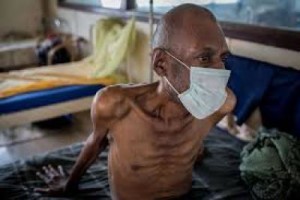 A TB patient. Photo credit: frontiersnews.com