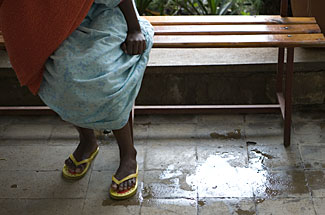 A woman suffering from inconvinience caused by obstetrics fistula. Photo credit: who.int