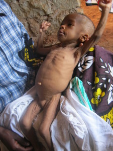 A malnourished child. Photo credit: ghp.usa.org