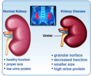 Normal kidney versus diseased kidney. Photo credit: medicinestonybookmedicie.edu