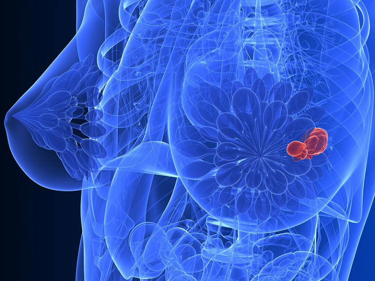 Breast cancer care partnership launched in Kenya