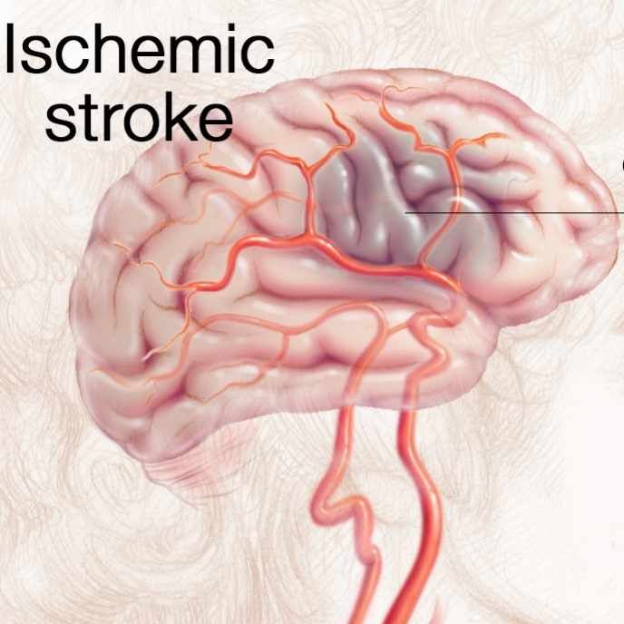 Stroke