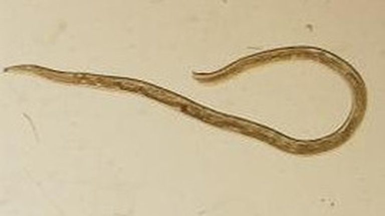 American woman found with eye worm previously known only in cattle