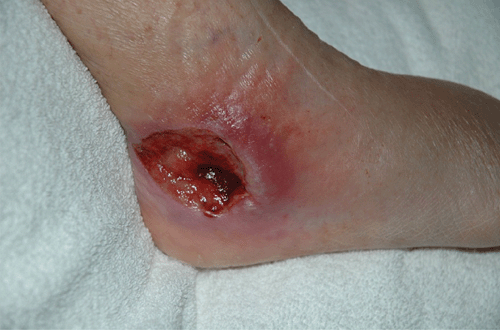 Flesh-eating bacteria